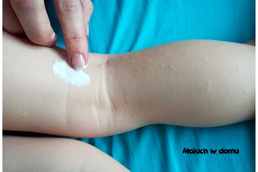 Wiedza w pigułce – atopowe zapalenie skóry