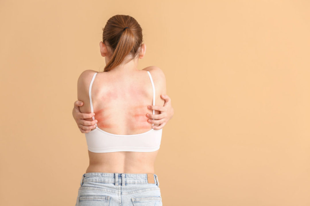 Atopowe zapalenie skóry – co należy wiedzieć na ten temat